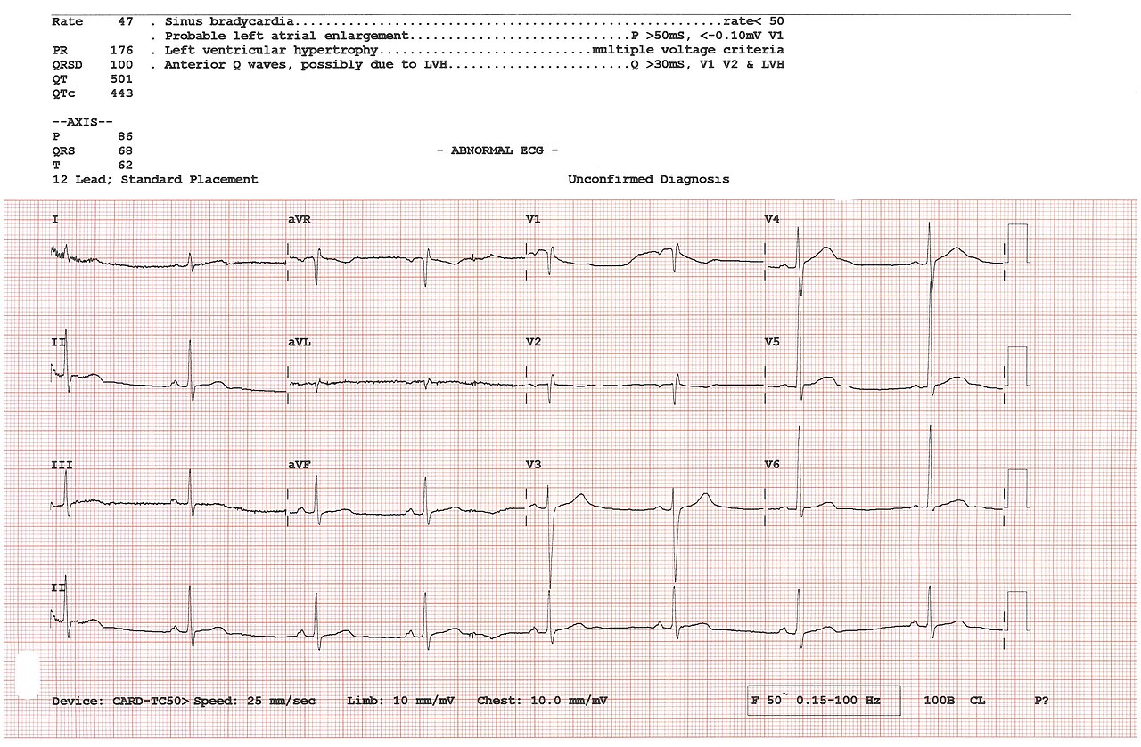 Cardiolog Pașcani – electrocardiogramă cu 12 derivații